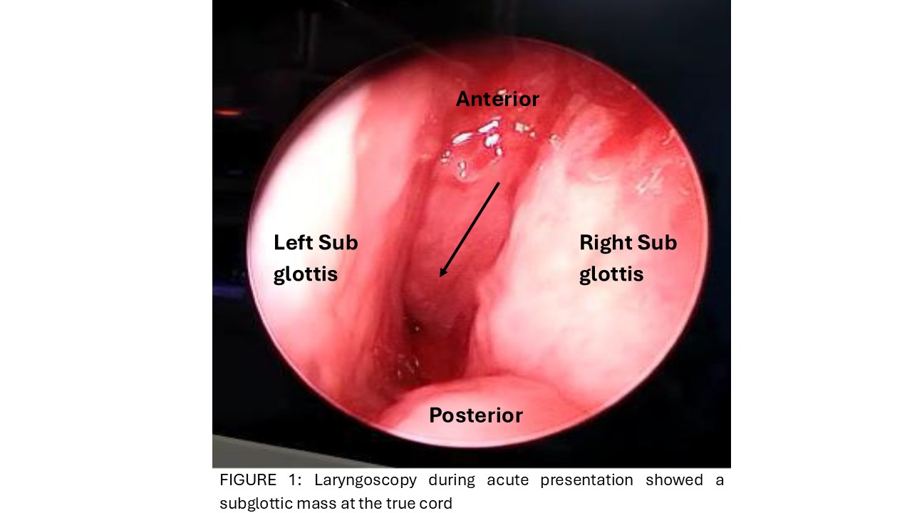 Laryngoscopy during acute presentation showed a subglottic mass at the true cord