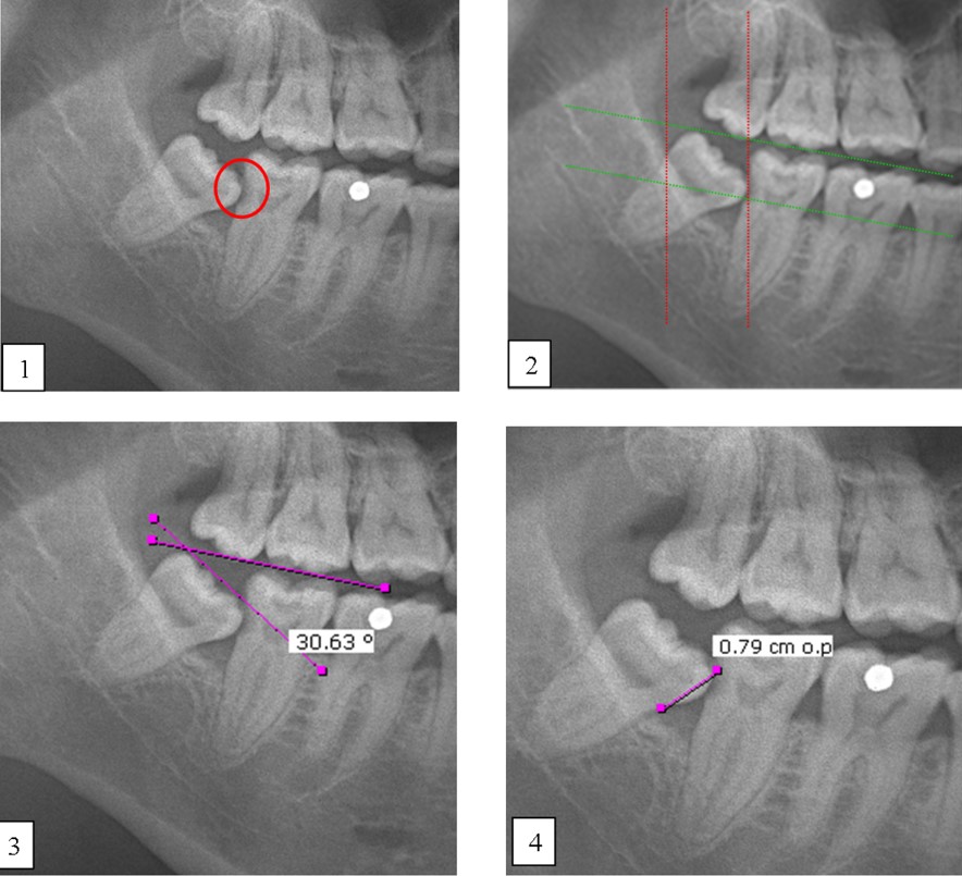 Caries and impacted MTM impaction: (1) Distal caries on MSM; (2) The depth and space of MTM was determined by the Pell & Gregory classification method; (3) The Shiller classification applied in determining the angulation of impacted third molar; (4) The distance between the distal CEJ of the MSM and mesial CEJ of the MTM was calculated as described in Leone classification