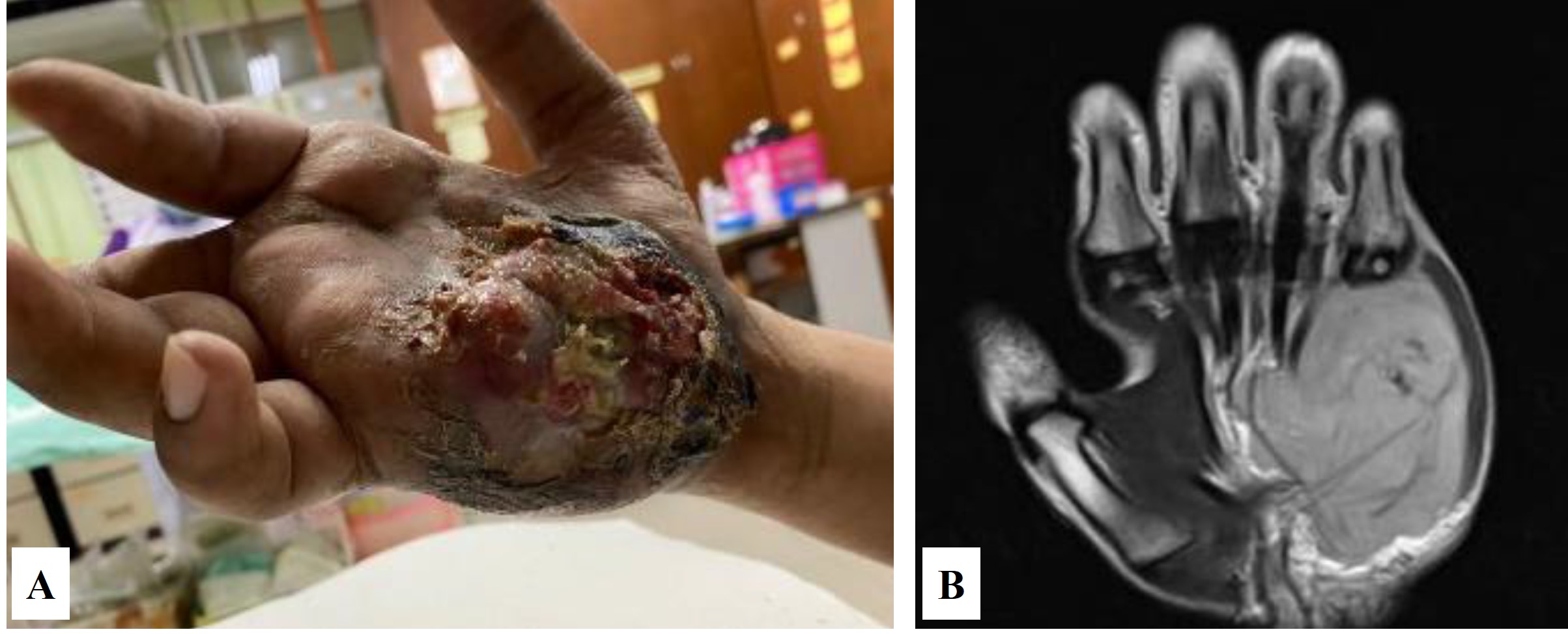 Case 1 (A) A fungating and ulcerated soft tissue mass over the hypothenar region of the right hand; (B) Coronal T1-weighted MR image showing a lobulated, homogeneous lesion involving the hypothenar muscles.