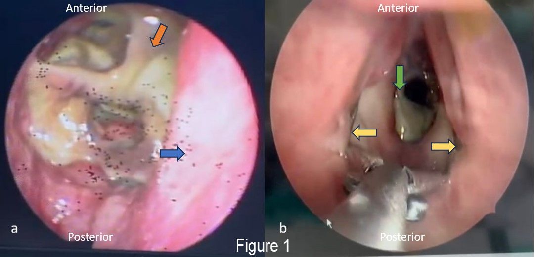 (a) Bedside FNPLS of subglottic view, revealed thick greenish mucopus at the subglottis and slough within necrotic tracheal mucosa (orange arrow), blue arrow showed right wall subglottic area; (b) Direct laryngoscopy with laryngeal spreader lateralising bilateral true cords (yellow arrow) showing that there was a necrotic segment of the trachea (green arrow) which then removed.