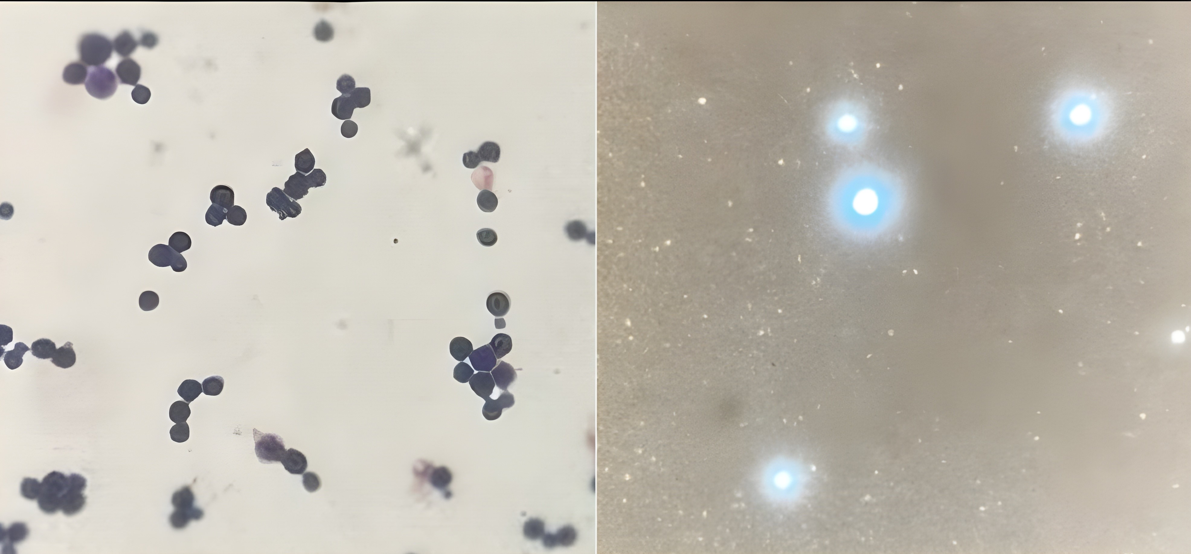 Left: Gram stain showing round yeast cells with budding; Right: India ink preparation positive for encapsulated yeasts