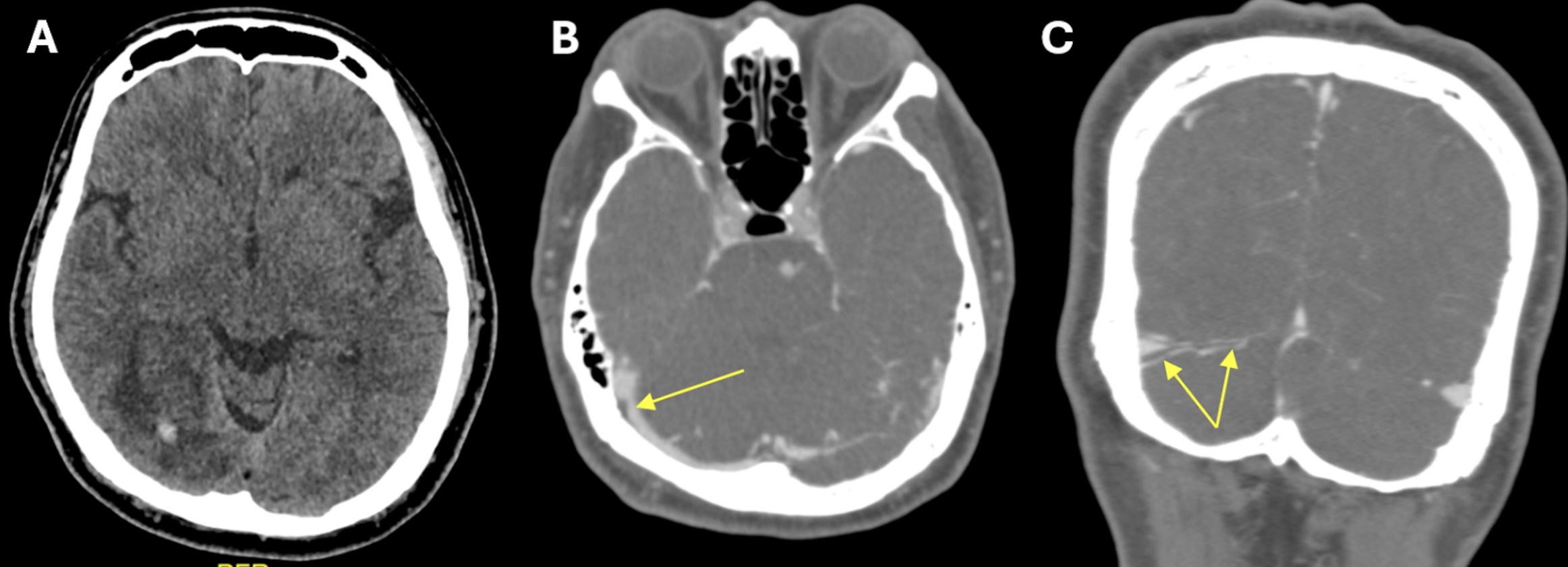 FIGURE 1: (A) Non-contrast CT brain demonstrated acute focal hemorrhage at the right occipital lobe withperihemorrhagic hypodensity extending to the right parieto-occipital region; (B) Subsequent CT venography in axial plane revealed thin linear isodensity within the right transverse sinus; (C) CT venography in coronal plane confirmed the filling defect within the right transverse sinus, consistent with thrombus