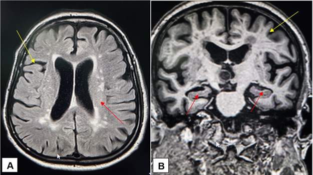 Non-contrast MRI of the patient’s brain showing generalised cortical atrophy (yellow arrows) and loss of hippocampal volume (red arrows) in (A) FLAIR image and (B) Coronal T1 image of the patient’s brain. These structural changes were consistent with neurodegenerative patterns observed in Alzheimer's disease. 