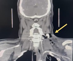 FIGURE 1: Yellow arrow in coronal cut of CECT neck showed hyperdense foreign body measuring 1.8 x 2.8 x 2.5 cm in the left posterior cervical soft tissue at the C5-C6 level