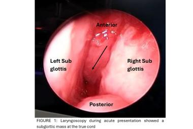 Laryngoscopy during acute presentation showed a subglottic mass at the true cord