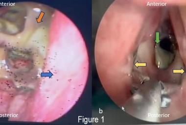 (a) Bedside FNPLS of subglottic view, revealed thick greenish mucopus at the subglottis and slough within necrotic tracheal mucosa (orange arrow), blue arrow showed right wall subglottic area; (b) Direct laryngoscopy with laryngeal spreader lateralising bilateral true cords (yellow arrow) showing that there was a necrotic segment of the trachea (green arrow) which then removed.