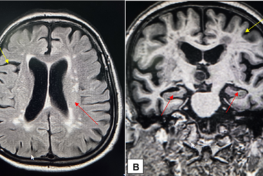 Non-contrast MRI of the patient’s brain showing generalised cortical atrophy (yellow arrows) and loss of hippocampal volume (red arrows) in (A) FLAIR image and (B) Coronal T1 image of the patient’s brain. These structural changes were consistent with neurodegenerative patterns observed in Alzheimer's disease. 