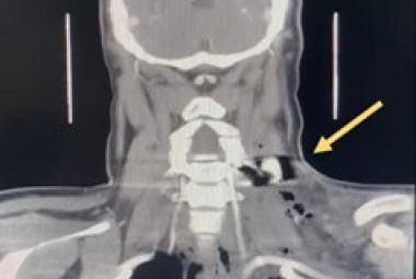 FIGURE 1: Yellow arrow in coronal cut of CECT neck showed hyperdense foreign body measuring 1.8 x 2.8 x 2.5 cm in the left posterior cervical soft tissue at the C5-C6 level