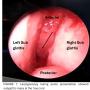 Laryngoscopy during acute presentation showed a subglottic mass at the true cord
