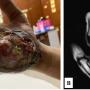 Case 1 (A) A fungating and ulcerated soft tissue mass over the hypothenar region of the right hand; (B) Coronal T1-weighted MR image showing a lobulated, homogeneous lesion involving the hypothenar muscles.