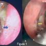 (a) Bedside FNPLS of subglottic view, revealed thick greenish mucopus at the subglottis and slough within necrotic tracheal mucosa (orange arrow), blue arrow showed right wall subglottic area; (b) Direct laryngoscopy with laryngeal spreader lateralising bilateral true cords (yellow arrow) showing that there was a necrotic segment of the trachea (green arrow) which then removed.