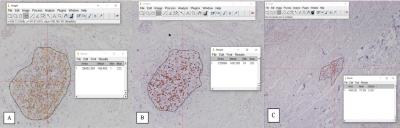 Figure 1: Surface area of immunostaining region covered by both tumor-infiltrating lymphocytes (TILs) subsets was calculated using ImageJ software (20X magnification). A) Surface area of immunostaining region covered by CD4+ TILs in one of the samples; B) Surface area of immunostaining region covered by CD8+ TILs in one of the samples; C) Surface area of immunostaining region covered by IL-10 in one of the samples.