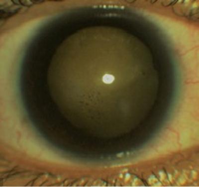 Figure 1: Anterior segment photograph of the right eye showing multiple sub-epithelial corneal opacities with keratic precipitates on endothelium