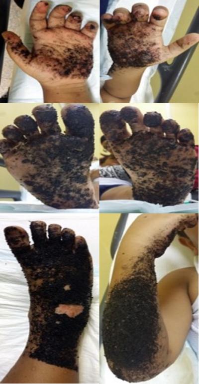 Figure 1: Initial presentation of severe tar burn injuries