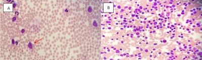 Figure 1: A) Peripheral blood film at diagnosis, showed presence of 5% abnormal lymphoid cells (Wright stain, 400x). B) Bone marrow aspiration smear at diagnosis showed hypercellular marrow with numerous abnormal lymphoid cells (MGG stain, 400x).