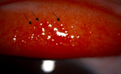 Figure 1: Photographs showing the everted upper eyelids of the patient with presence of follicles on the tarsal conjunctiva before treatment with fucithalmic ointment. Follicles were shown with black arrows.