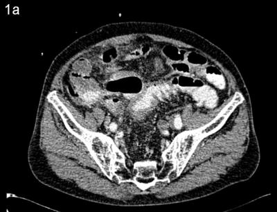 Figure 1a: Contrast enhanced computed tomography showing diffuse thickening of the rectosigmoid colon 